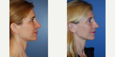 35-44 year old woman treated with Revision Rhinoplasty - 40 year old woman undergoing rhinoplasty