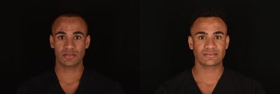 Man treated with Laser Treatment using Pixel Laser - Man treated with Laser Treatment using Pixel Laser
