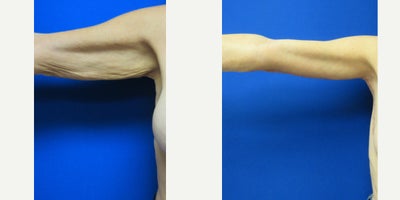 Arm Lift - Patient wanted to have the excess skin removed from her arms so she could wear short sleeve tops comfortably.