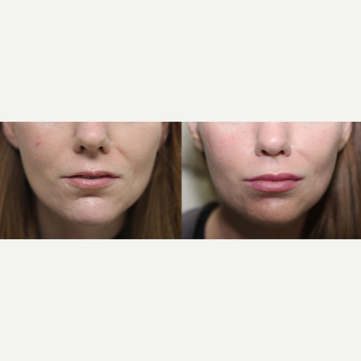 35-44 year old woman treated with Silikon 1000 - This patient was treated with Silikon 1000 to provide more symmetry and volume for a refreshed and youthful appearance!
