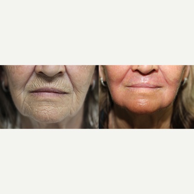 65-74 year old woman treated with Phenol Peel - Before and 1 month post op of the Hetter Peel performed on this lovely 72 year young patient with outstanding results!