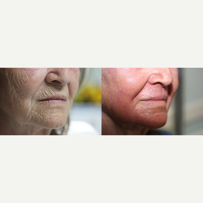 65-74 year old woman treated with Phenol Peel - Before and 1 month post op of the Hetter Peel performed on this lovely 72 year young patient with outstanding results!