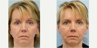 45-54 year old woman treated with Radiesse - Lateral soft tissue descent around the cheek and mouth contributes to a saddened look.  Using fillers to plump the area of volume deficiency restores a youthful appearance.  She epitomizes the phrase Aging doesn't have to show.