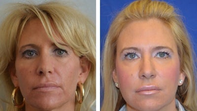 35-44 year old woman treated with Sculptra - Sculptura treatment