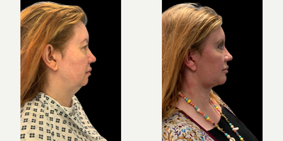 Woman treated with Brow Lift - Woman treated with Endoscopic Brow Lift shown 6 months post op. She also had facelift, neck lift with platysmaplasty, upper blepharoplasty, submental liposuction and chin implant.