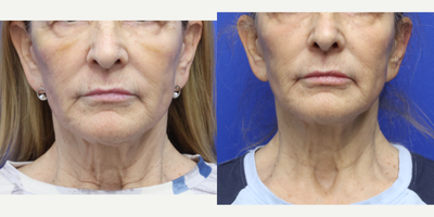 65-74 year old woman treated with Ellacor - 69 year old woman 7 weeks post One Ellacor treatment to the midface and central/upper neck. She has noticed improved fine lines of the mouth, cheek, along the jaw line as well as improvement in the crepiness of the neck skin.