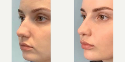 25-34 year old woman treated with NovaThreads - Nonsurgical rhinoplasty with PDO threads , immediate results, minimally invasive procedure under local anesthesia