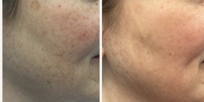 45-54 year old woman treated with Lumecca - Lumecca by InMode is the most advanced and innovative broad-spectrum intense pulsed light (IPL) treatment that harnesses the full power of an IPL treatment in just three sessions. Lumecca is designed to treat sun spots (red/brown pigmentation), redness (rosacea), freckles, vascular lesions and improve overall skin complexion. The most common areas of treatment are those areas regularly exposed to the sun including the face, neck, legs, hands and arms.