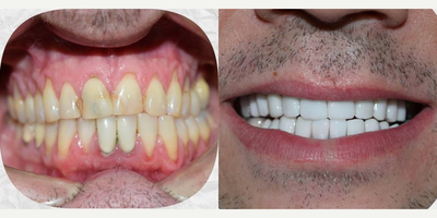Man treated with Porcelain Veneers, Dental Crown - Someone is going to smile more than normal this weekend with this great combination of porcelain veneers and dental crowns.