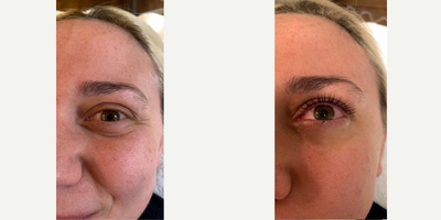 Woman treated with Yumi Lash Lift - Woman treated with Yumi Lash Lift