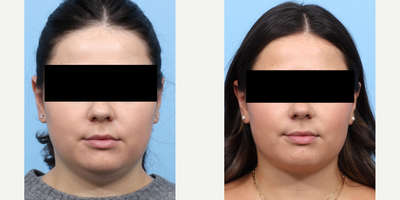 25-34 year old woman treated with Chin Liposuction - This 26-year-old patient wanted to eliminate her double chin and enhance her jawline. Dr. Wise performed submental liposuction, also known as chin liposuction, to achieve the patient's desired results of a more defined profile.