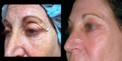 55-64 year old female treated with TotalFX - This patient underwent TotalFX laser resurfacing. The DeepFX laser handpiece was used to treat around the eyes and around the mouth. The ActiveFX laser handpiece was used to treat the entire face.