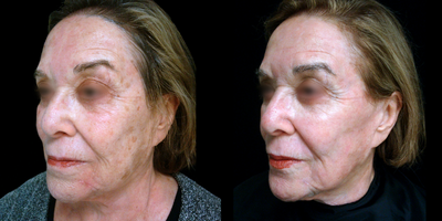 65-74 year old woman treated with ActiveFX - This patient underwent TotalFX laser resurfacing. The DeepFX laser handpiece was used to treat around the eyes and around the mouth. The ActiveFX laser handpiece was used to treat the entire face.