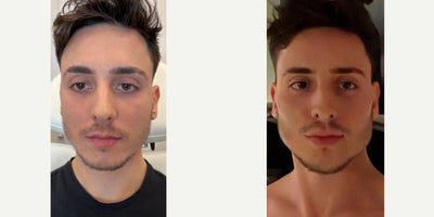 25-34 year old man treated with Chin Filler, Cheek Fillers, Thread Lift, Lip Fillers - Our patient is a regular who has been coming to us for years for all his facial sculpting needs. He loves an angular, sharp look to his features and trusts only us to provide that to him. He's back now for an update to his filler and this time he wants threads as well. Filler and threads in tandem are going to give him the maximum amount of sculpting possible and he's so excited to see his final results after everything settles in the days to come. WHAT WE DIDWe injected filler to many areas: his lips, chin, jawline, mid face, temples, and under eyes to contour and improve his volume. Additionally, we inserted threads in his mid face and his neck to add a further degree of tightening and definition. He's swollen right now, but did not find the process very painful. He absolutely cannot wait to see how it looks in a week. Stay tuned to see his final results!