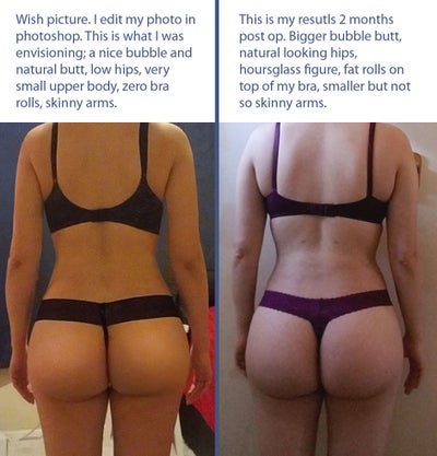 BBL 125lbs, 26 Years, 5.4 Got a fake droopy butt - Review - RealSelf