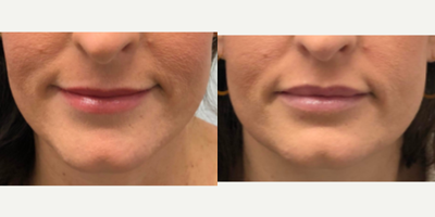 35-44 year old woman treated with Injectable Fillers in Lips - Treated with 1 syringe of Revanesse Versa for a subtle plumping effect and a defined cupids bow.