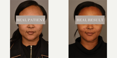 Woman treated with Buccal Fat Removal - Woman treated with Chin/Neck Liposuction, Cheek Liposuction, and Buccal Fat Removal to reduce the roundness of her face while still maintaining a natural look, shown 3 months post op.