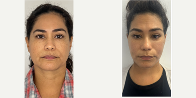45-54 year old woman treated with Facelift, Deep Plane Facelift, Buccal Fat Removal - 50 y.o female who underwent deep plane facelift, necklift, buccal fat reduction, facial fat transfer. She was awake yet comfortable for the procedure