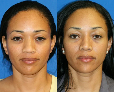 Rhinoplasty - 	rhinoplasty