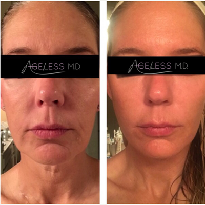45-54 year old woman treated with Thread Lift - Incredible results of the MINT thread Lift procedure the most advanced threads available from Korea in the US. These thread have the most superior lifting effect compared to all the other threads out there and longest lasting. This was a lower face thread lift where the patient was trying to lift her jowels and in fact pulled her sagging skin in her neck as an additional benefit.