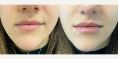 18-24 year old woman treated with Injectable Fillers - Immediately after 1/2 syringe of volbella to the lips done by PA Steve.