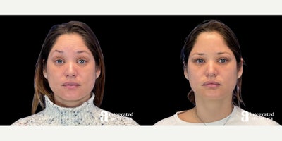 35-44 year old woman treated with Dysport - The patient is a 38-year-old female who had concerns about fine lines and wrinkles on her upper face. Dr. Chiang used wrinkle relaxer (Dysport) to treat the forehead, glabella, crows feet, and lower brows to address these concerns. The after results are 2 weeks post-treatment.