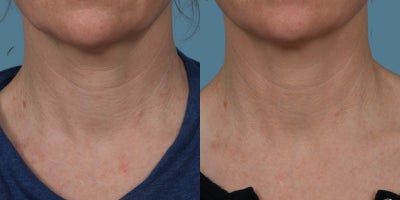 45-54 year old woman treated with Radiesse, Sculptra - Our patient is thrilled with her results and has graciously agreed to share photos of her neck highlighting that treatment area. This natural transformation was achieved not with filler, but with Sculptra and Radiesse. These powerhouse injectable treatments work by producing our bodys youthful skin-firming proteins to restore lost volume and elasticity, reducing fine lines and wrinkles. Sculptra is more of a gradual result over a period of weeks to months and was placed in the patients midface. Radiesse can achieve gratifying results in a shorter time period and was placed in the patients neck for a tightening effect. One maintenance treatment is recommended per year to boost the bodys collagen stimulation.