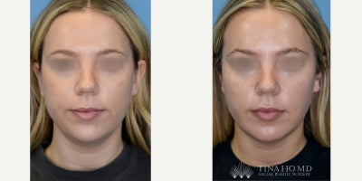 25-34 year old woman treated with Buccal Fat Removal, Mini Neck Lift - 28 year-old female who underwent buccal fat removal and deep mini neck lift for facial contouring as well as jawline contouring and neck rejuvenation.