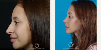 18-24 year old woman treated with Rhinoplasty - Another beautiful result after primary rhinoplasty