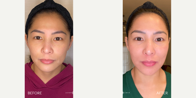 25-34 year old woman treated with Bellafill, Halo Laser, ProFractional Laser - Our patient has experienced changes in her environment that caused her to have some breakouts. This unfortunately left her with acne scars and pigmentation. We developed a custom treatment plan to help her accomplish her goals and get her skin back to looking flawless. Treating a sensitive skin type like her required a chemical peel. This helped to give us a clean canvas to work on for laser, reduce pigmentation, and prevent hyperpigmentation after her treatment. After treatment she noticed that her skin tone was more even, glowing, and immaculately textured.  ACNE SCAR COMBINATION TCA Cross Bellafill Halo laser ProfractionalNo treatment is complete without EMER SKIN. Using our products post-treatment will enhance results to the absolute maximum.