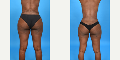 35-44 year old woman treated with Abdominal Etching, Belly Button Surgery, Diastasis Recti Repair, Liposuction Revision, Mini Tu - This patient was unhappy with the results of her tummy tuck done by another doctor.  I did a REVISION tummy tuck.  I lowered her scar so that it could be covered in underwear and bikini bottoms.  I did VASER ultrasound Liposuction 360 to thin and shape her waist giving her a more hourglass shape.  I re-plicated her muscles in the midline and on the sides to cinch in her waist and flatted her abdomen more.  Finally, I revised her belly button to make it more inset and smaller.