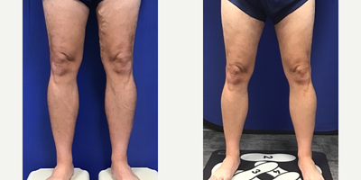 42 year old male after having Endovenous Laser Ablation - This 42 year old patient is thrilled with his results after having Endovenous Laser Ablation with Dr. Craig Schwartz.