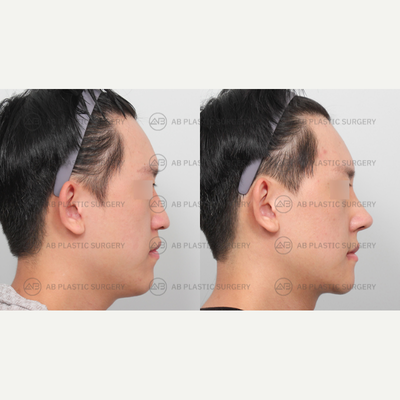 25-34 year old man treated with Genioplasty, V Line Surgery, Asian Rhinoplasty - By: Dr. Ahn Seung Hyun, Dr. Kim Joo Yeon