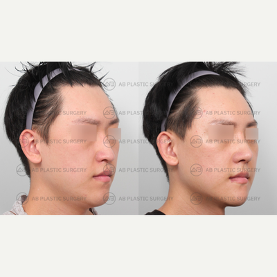 25-34 year old man treated with Genioplasty, V Line Surgery, Asian Rhinoplasty - By: Dr. Ahn Seung Hyun, Dr. Kim Joo Yeon