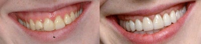 Mid-20s Female, Gum Lift Procedure - Patient had gummy smile that she was displeased with. A crown lengthening procedure and trimming the gum line was performed.