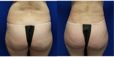 25-34 year old woman treated with Power-Assisted Liposuction (PAL) - 37 year old female who had liposuction of the back and abdomen with fat transfer to the buttocks. Liposuction was performed using Vaser and Power Assisted Liposuction. A total of 3.5 Liters was removed with 1 liter from the lower back. 750cc's was placed in each buttock. The patient's height is 5 foot 3 inches. Her weight was 134 lbs. She has two children.