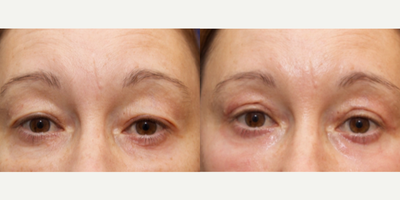 Woman treated with Chemical Peel - Woman treated with Chemical Peel