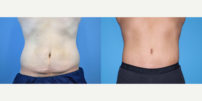 25-34 year old man treated with Body Lift - 31 year old male received a lower body lift; photos depict the patient's results 13 months post-op.