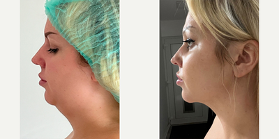 25-34 year old woman treated with Chin Liposuction - 26 years old female, underwent double chin removal via liposuction.