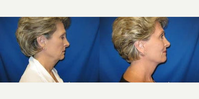 55-64 year old woman treated with Facelift - 55-64 year old woman treated with Facelift
