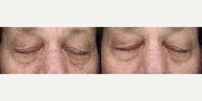 65-74 year old man treated with Scar Removal, Laser Scar Removal - Treated sebatious hyperplasia around the eyes