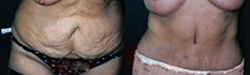 Panniculectomy - Panniculectomy