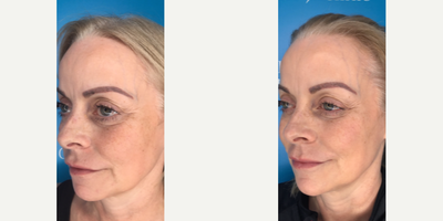 45-54 year old woman treated with Ellanse - This lady felt she was aging and she disliked that her eyes were dominating her face. She had Ellans S and M injected in a global manner and she was delighted with her holistic rejuvenation. In particular, she had temple, cheek, and chin injections with Ellans, and her old lip filler was dissolved and lips refilled, to achieve a really balanced face.