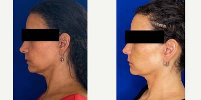 46 year old woman treated with Botox - 46 year old woman treated with Botox to platysma muscle on the neck to improve the sagging and with no downtime. Patient is shown before and 2 weeks after the treatment. Patient was also treated with Voluma filler to her cheeks.