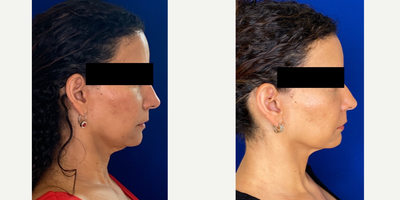 46 year old woman treated with Botox - 46 year old woman treated with Botox to platysma muscle on the neck to improve the sagging and with no downtime. Patient is shown before and 2 weeks after the treatment. Patient was also treated with Voluma filler to her cheeks.