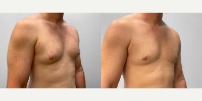 25-34 year old man treated with Gynecomastia Surgery - This man in his mid-thirties met with Dr. Howell to discuss his interest in gynecomastia correction surgery.  Dr. Howell performed his surgery via tumescent liposuction and SmartLipo and he has been very pleased with his results.  He is featured before and 2.5 months afterwards.