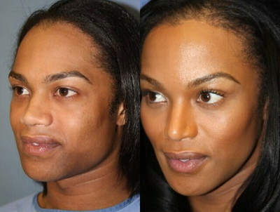 Woman treated with Jaw Reduction - Woman treated with Jaw Reduction