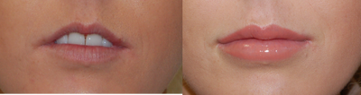 Lip Augmentation  - 	Lip augmentation