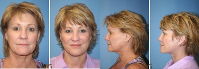 Facelift, Neck Lift & Eyelid Lift  - Like many women as we age our lower face starts to show signs of skin laxity and our once defined jawline starts to disappear. &nbsp;As we put on make-up we notice a change in our skin's elasticity and many of us develop a double eyelid. &nbsp;This patient decided to do ask around and ended up being referred to Dr. Kevin Sadati. &nbsp;The patient booked his Natural Facelift and an upper eyelid lift. &nbsp;All of these cosmetic surgery procedure were performed under local anesthesia and oral sedation. The recovery process was smooth and she was able to return to normal activity within one week. &nbsp;