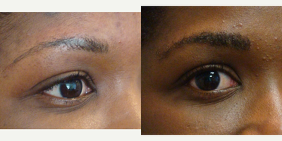 African American Female after eyebrow hair transplantation - Female patient had thin eyebrows and poor growth due to plucking. Transplanted one session, follow up 6 months.